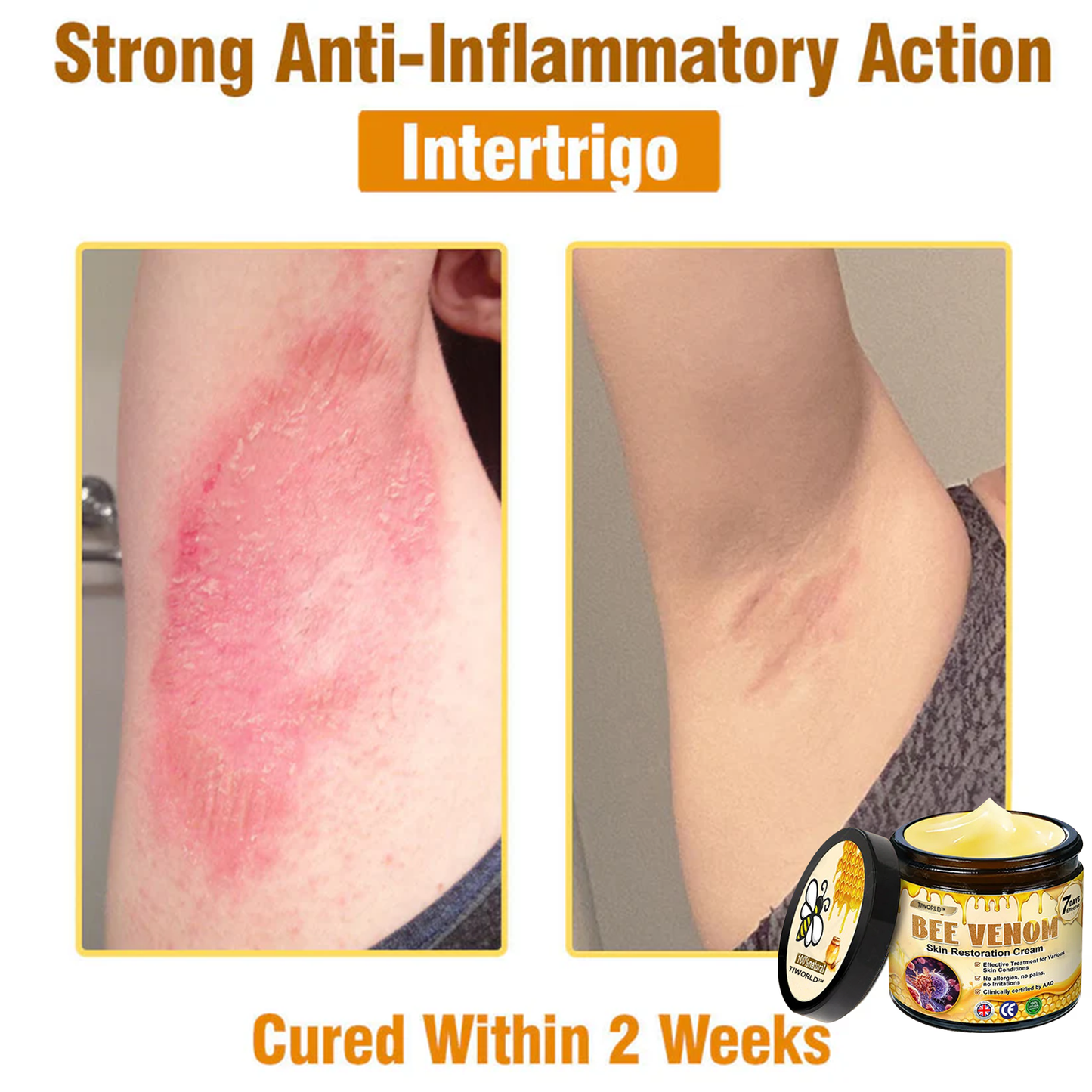 ✨✨Tiworld™ Bee venom Comprehensive Cream — 🔥Limited Time 80% OFF🔥